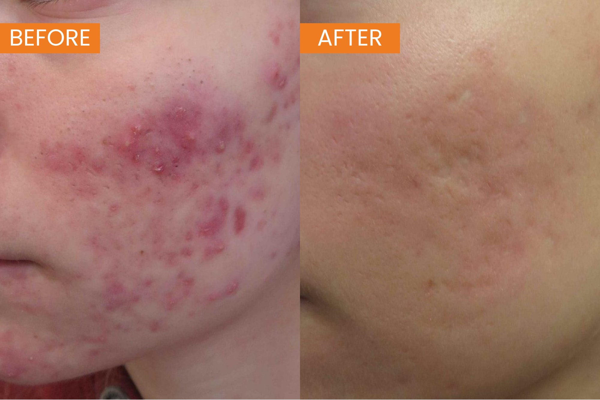 TDC GADS Acne Scarring B&A (1)