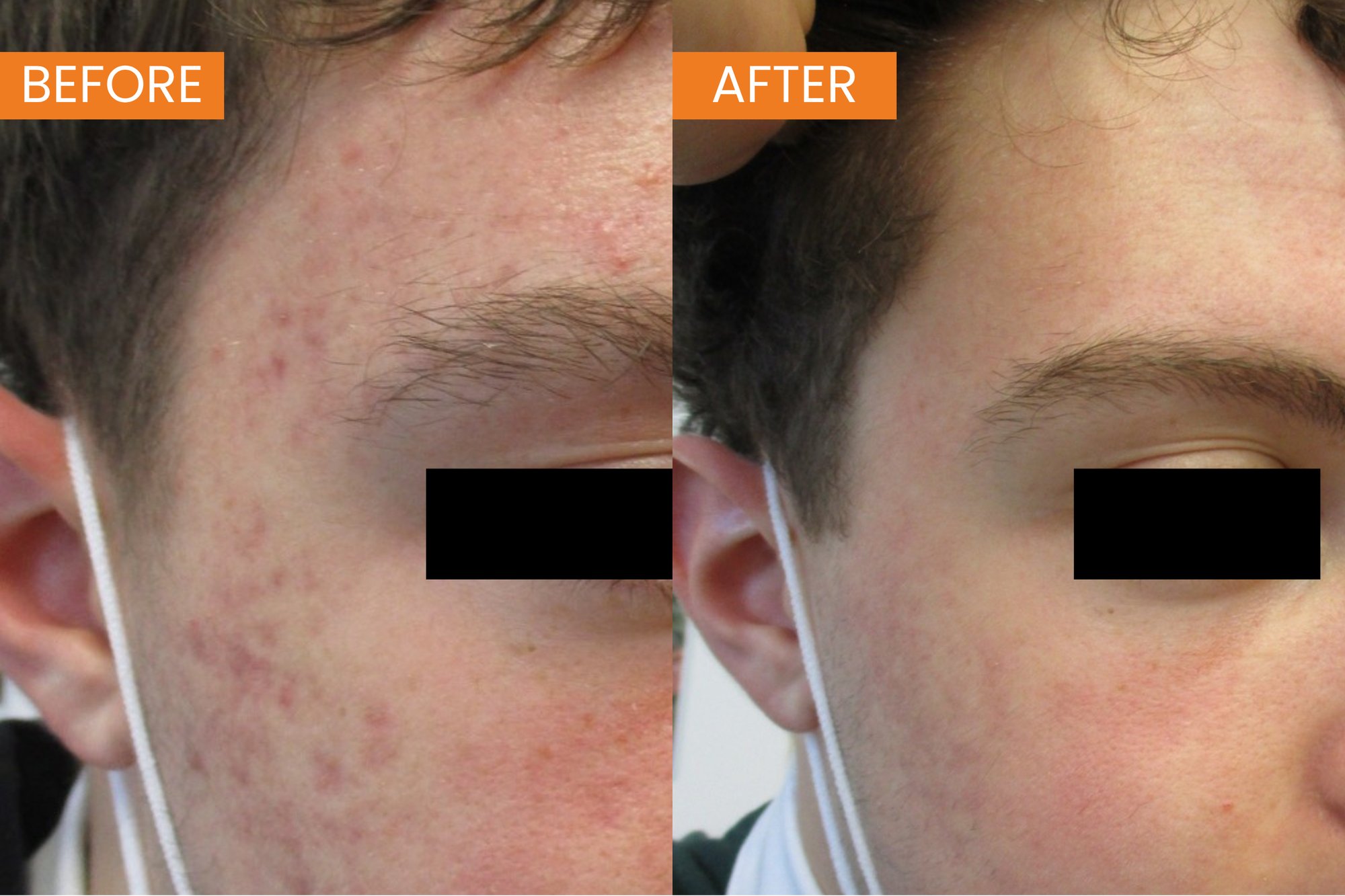 TDC GADS Acne Scarring B&A 