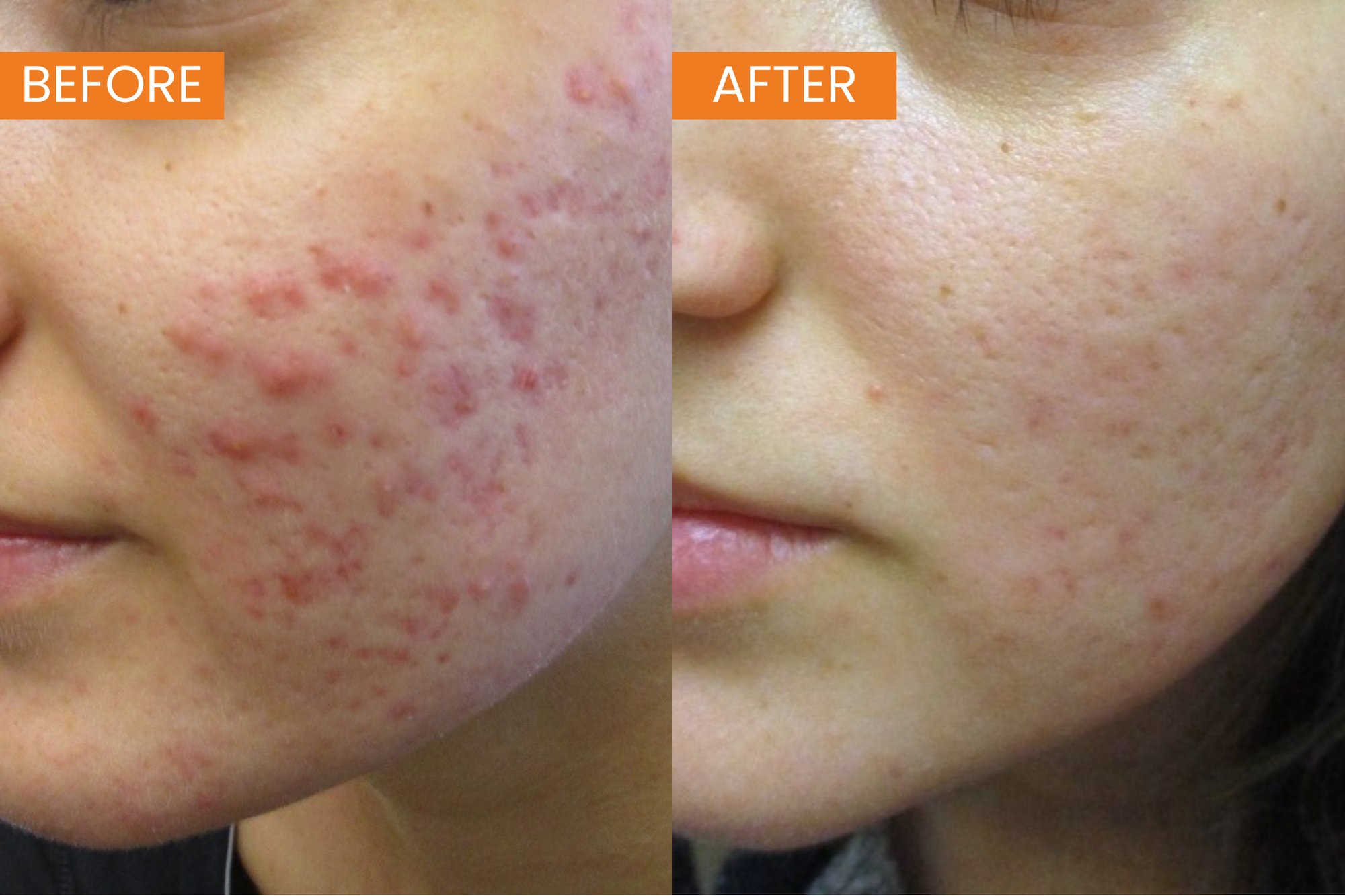 TDC GADS Acne Scarring B&A (4)